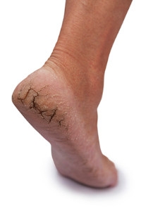 Preventing Cracked Heels