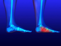 Conditions That May Cause Flat Feet