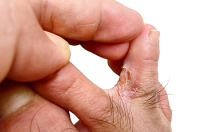The Vital Role of Hygiene in Combating Athlete's Foot