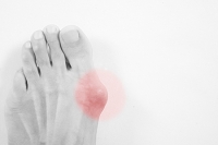 Possible Causes of a Bunion