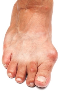 What Does A Bunion Look Like?