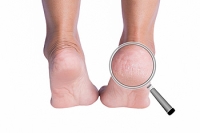 The Causes and Risks of Cracked Heels