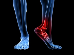 Symptoms of Sever s Disease