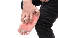 How Did I Contract Athlete’s Foot?