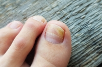 Toenail Fungus May Lead to Foot Conditions
