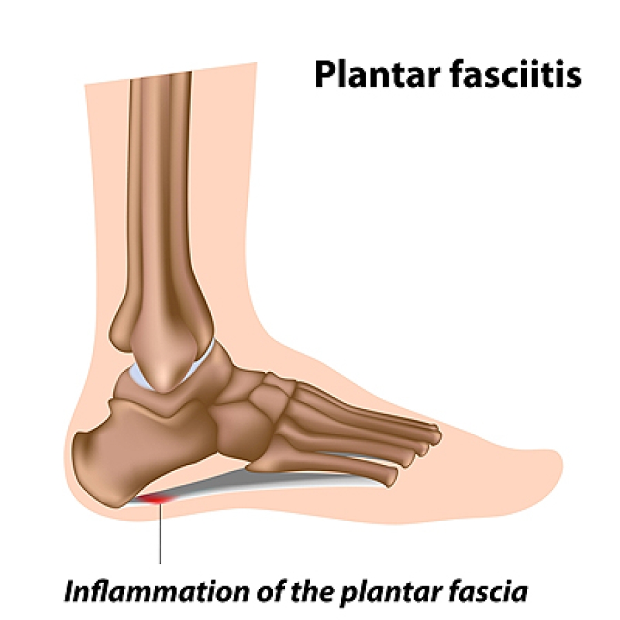 Pain on plantar fascia 2025