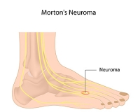 Everything You Should Know About Morton's Neuroma